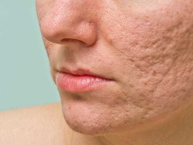 How to Get Rid Of Acne Scars